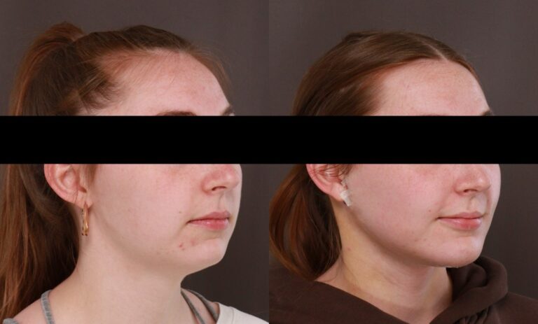 Before Image: Deep Neck Contouring - 
