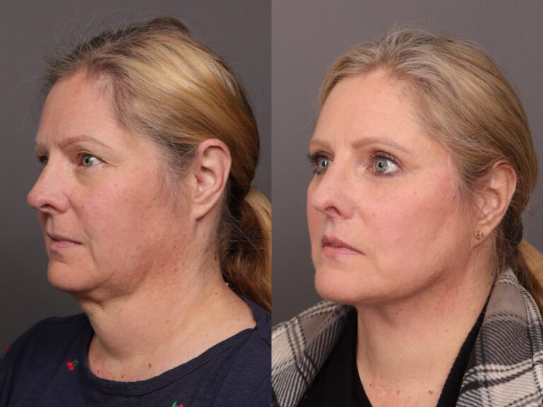 After Image: Facelift with Upper & Lower Blepharoplasty and Fat Grafting - front
