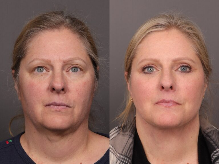 Before Image: Facelift with Upper & Lower Blepharoplasty and Fat Grafting - front