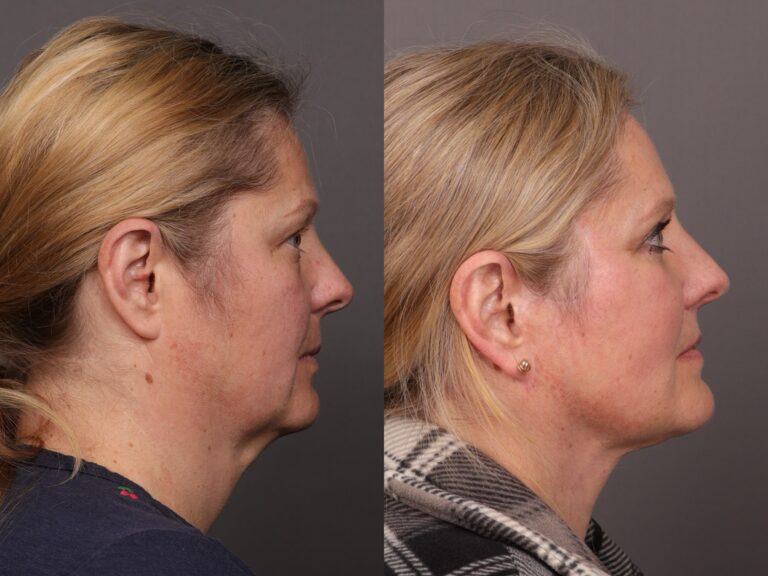 Before Image: Facelift with Upper & Lower Blepharoplasty and Fat Grafting - front