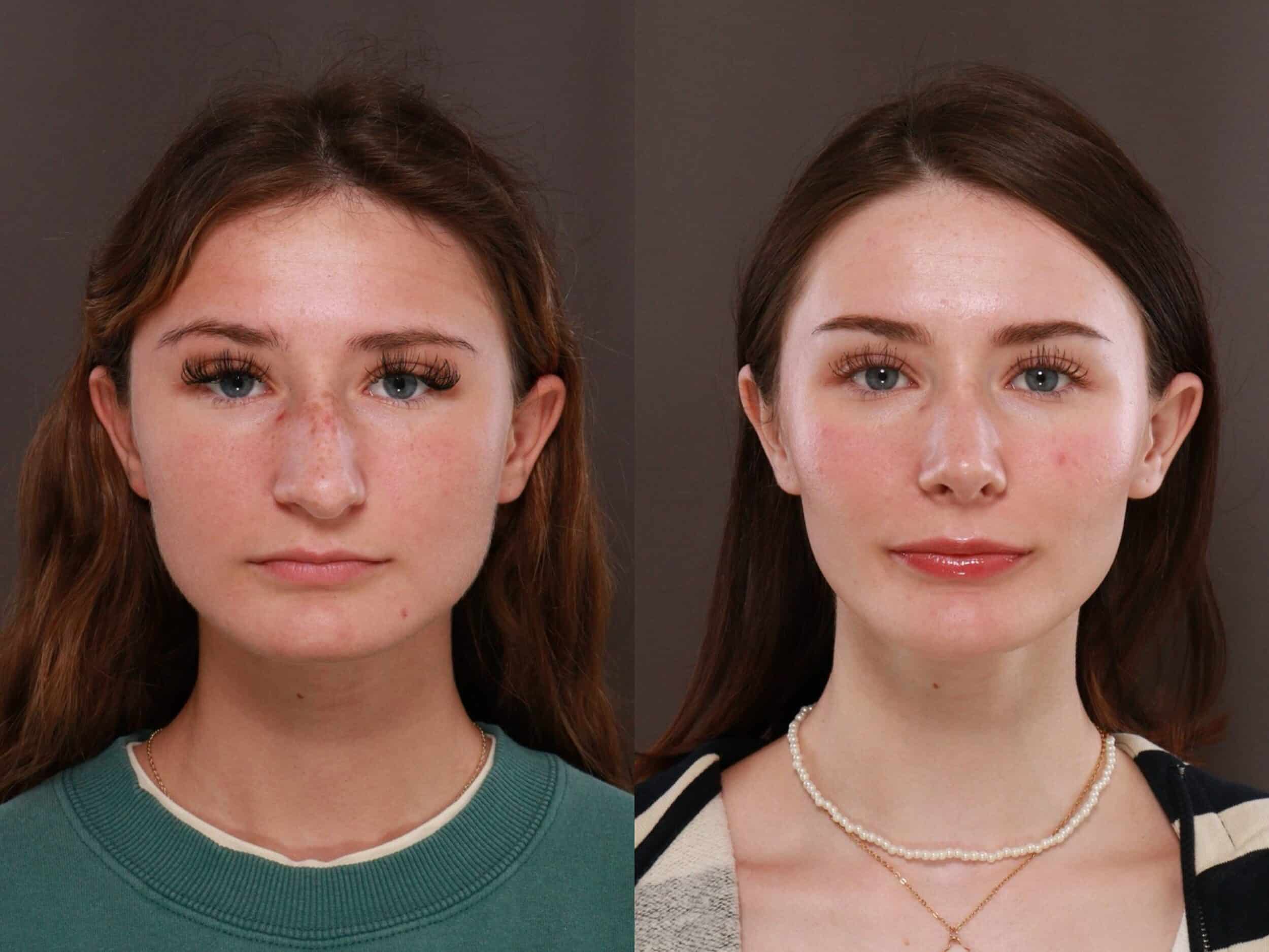 Rhinoplasty at Utah Facial Plastics