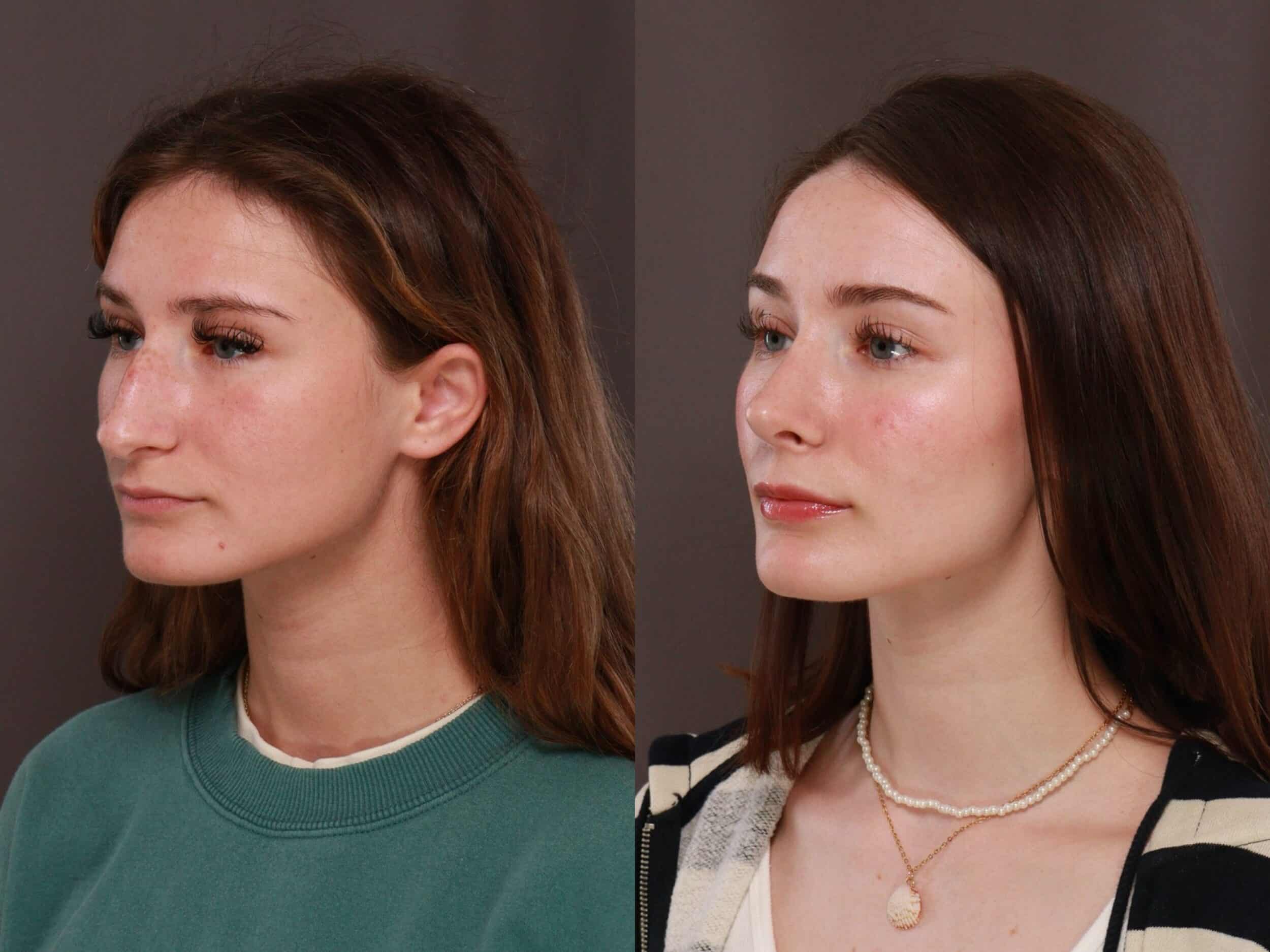 Rhinoplasty at Utah Facial Plastics