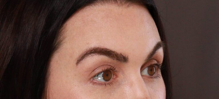 After Image: FUT Eyebrow Transplant - front