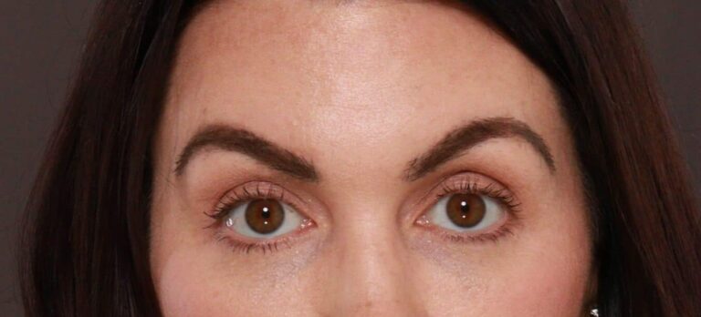 After Image: FUT Eyebrow Transplant - 