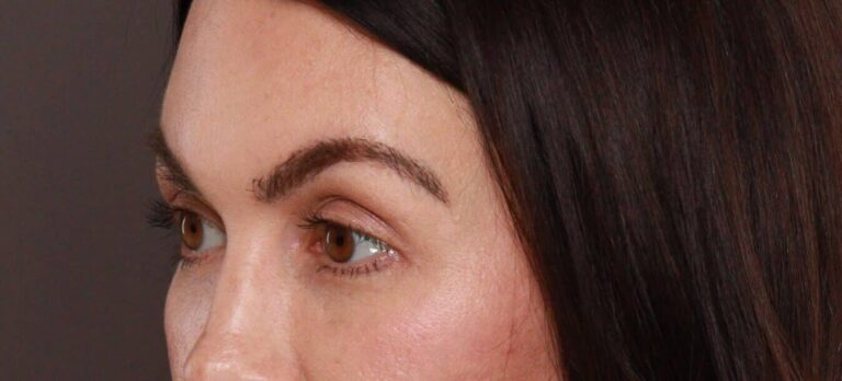 After Image: FUT Eyebrow Transplant - 