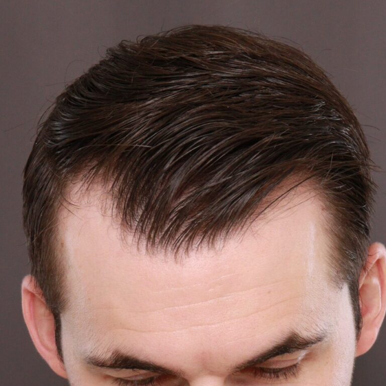 Before Image: FUE Hair Transplant, 1400 grafts - front