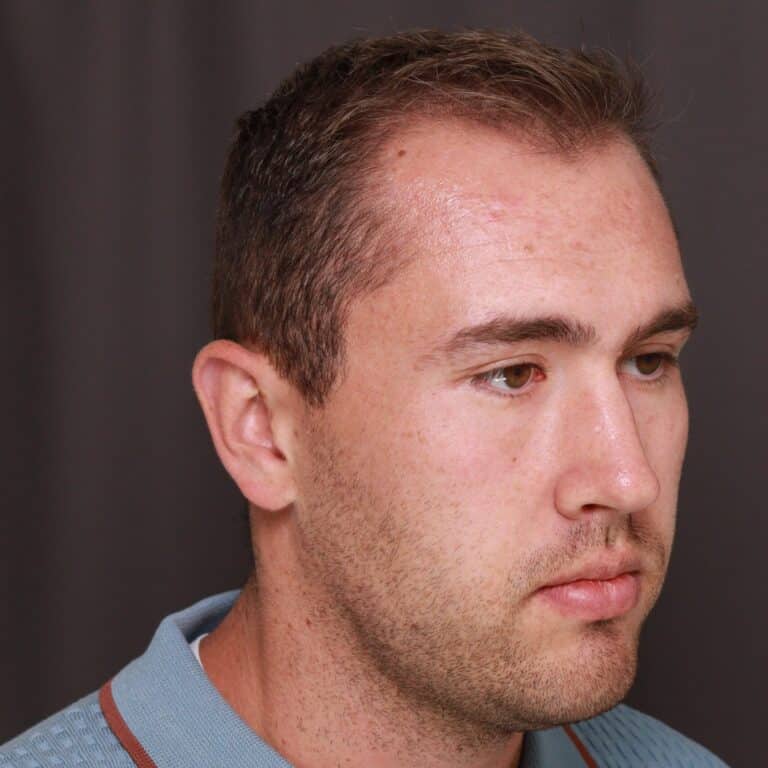 Before Image: FUT Hair Transplant, 1500 Grafts - front