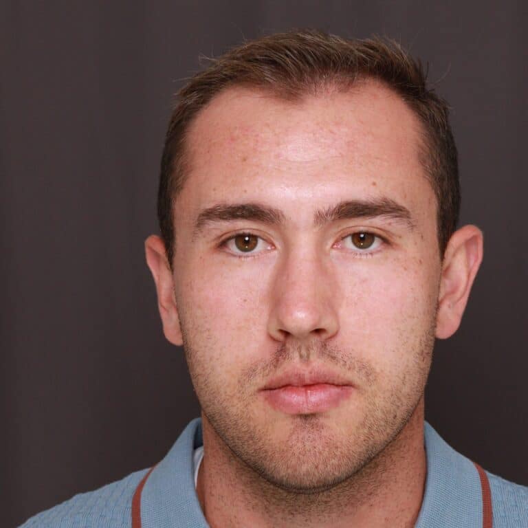 Before Image: FUT Hair Transplant, 1500 Grafts - front