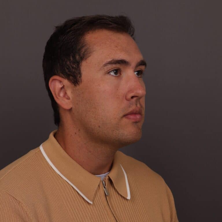 After Image: FUT Hair Transplant, 1500 Grafts - front