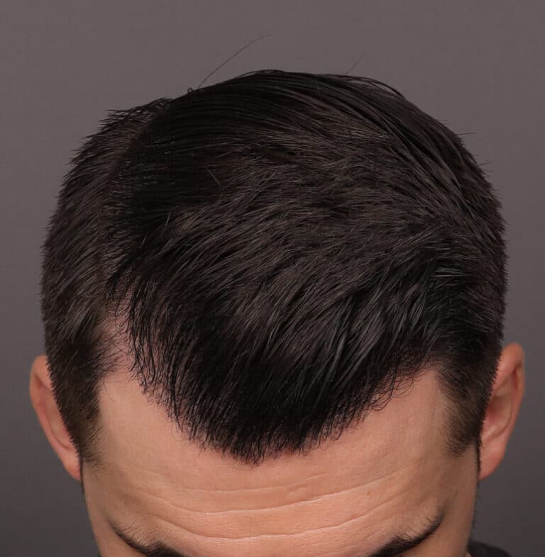 After Image: FUE Hair Transplant, 1400 grafts - front