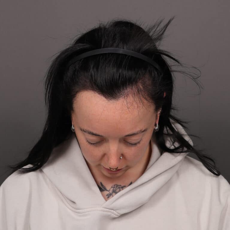 After Image: FUT Hair Transplant, 2600 grafts - front