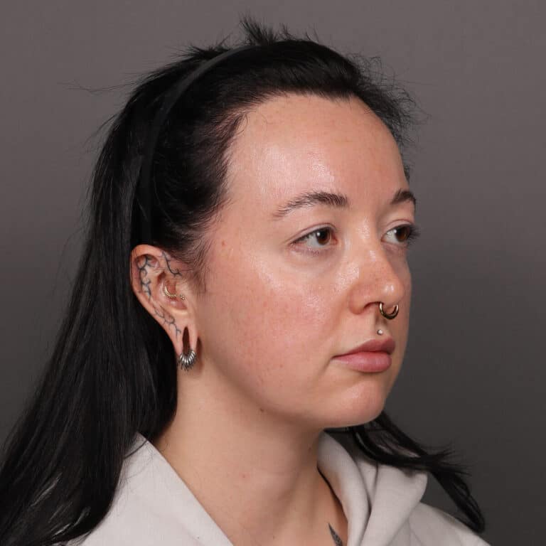 After Image: FUT Hair Transplant, 2600 grafts - 