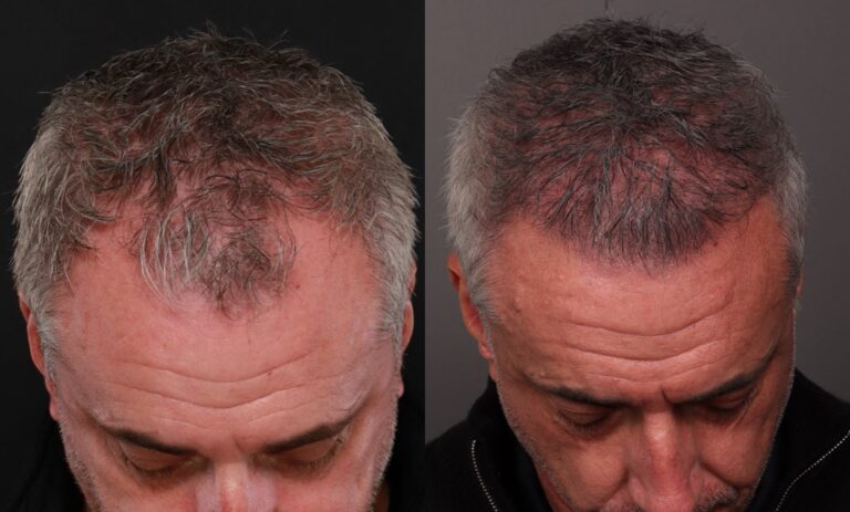 After Image: 2 FUT Hair Transplants - front