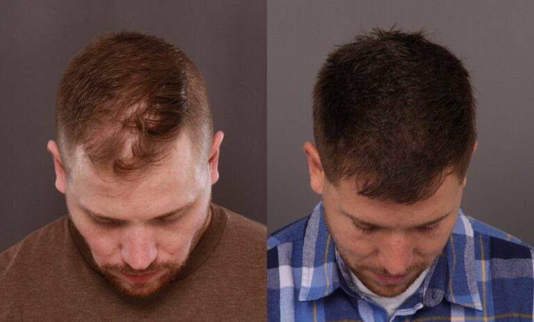 Before Image: FUE Hair Transplant - front