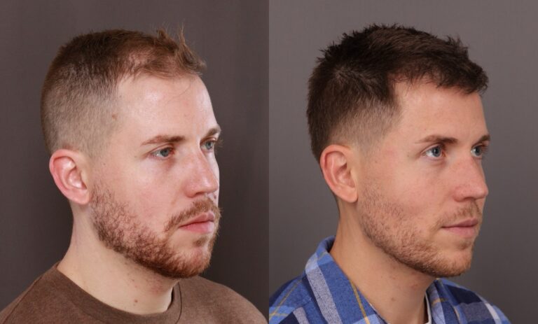 After Image: FUE Hair Transplant - front