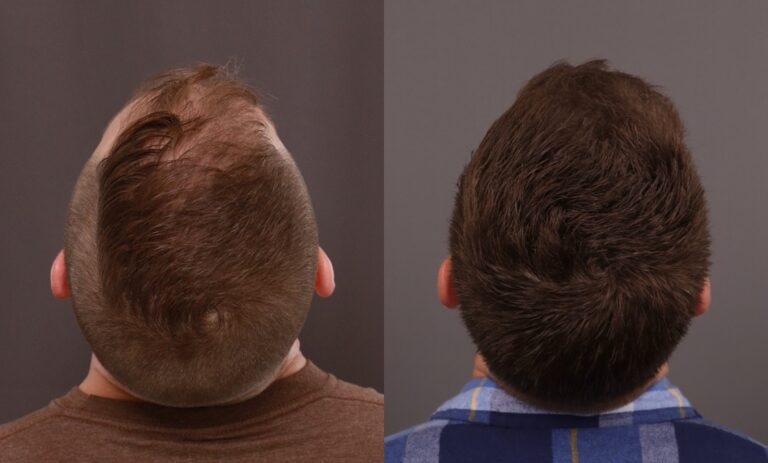 Before Image: FUE Hair Transplant - 