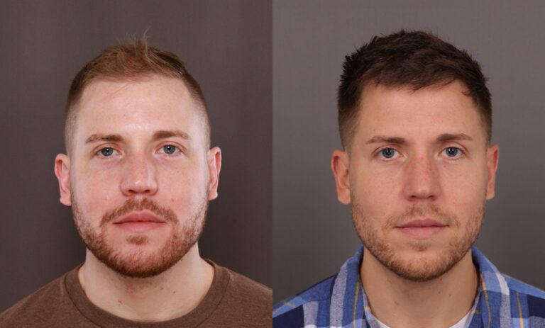 After Image: FUE Hair Transplant - 
