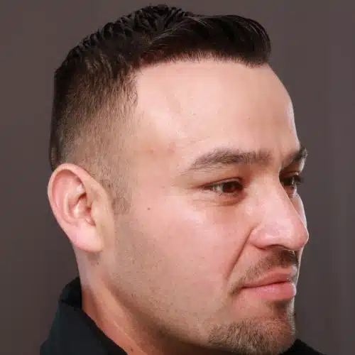 After Image: FUE Hair Transplant, 1400 grafts - front