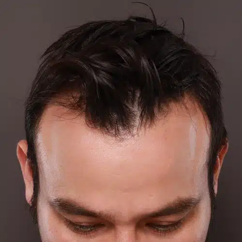 Before Image: FUE Hair Transplant, 1400 grafts - 