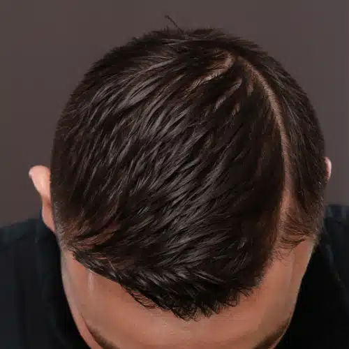 After Image: FUE Hair Transplant, 1400 grafts - 