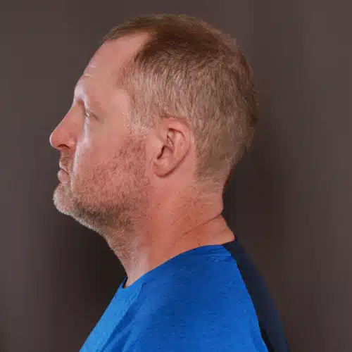 Before Image: Eyebrow Transplant - 