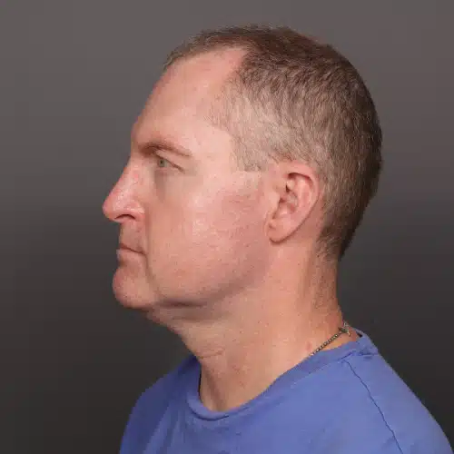 After Image: Eyebrow Transplant - 