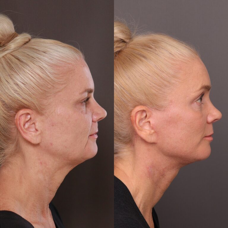 Before Image: Facelift, Brow lift, Halo, Contour TRL, Sculptra & Injectables - front