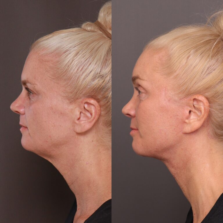 After Image: Facelift, Brow lift, Halo, Contour TRL, Sculptra & Injectables - front
