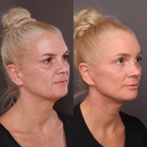 After Image: Facelift, Brow lift, Halo, Contour TRL, Sculptra & Injectables