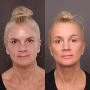 Before Image: Facelift, Brow lift, Halo, Contour TRL, Sculptra & Injectables