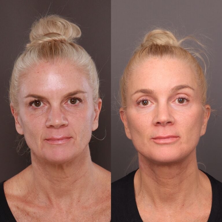 Before Image: Facelift, Brow lift, Halo, Contour TRL, Sculptra & Injectables - front