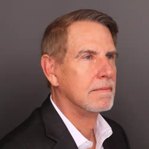 After Image: FUE Hair & Brow Transplant, 2700 grafts - 