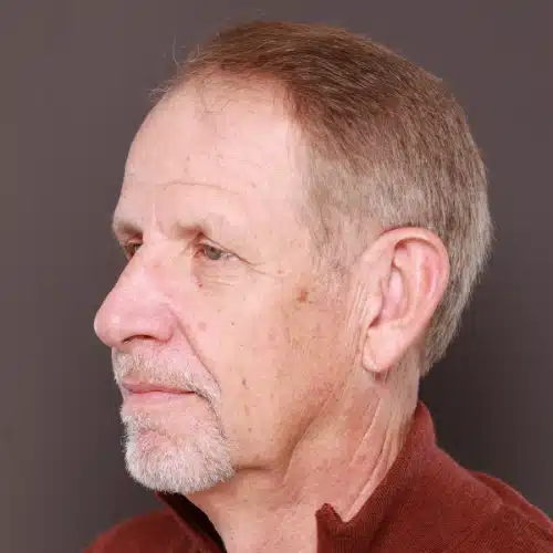 Before Image: FUE Hair & Brow Transplant, 2700 grafts - 