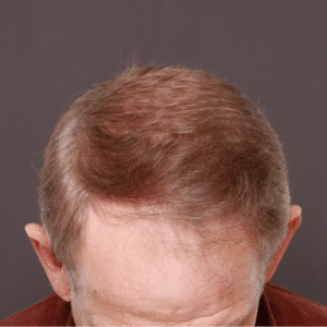 Before Image: FUE Hair & Brow Transplant, 2700 grafts