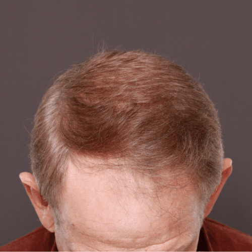 Before Image: FUE Hair & Brow Transplant, 2700 grafts - front