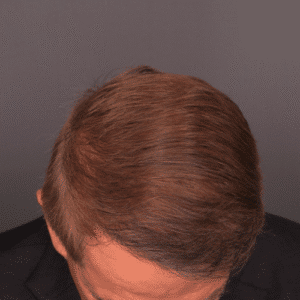 After Image: FUE Hair & Brow Transplant, 2700 grafts