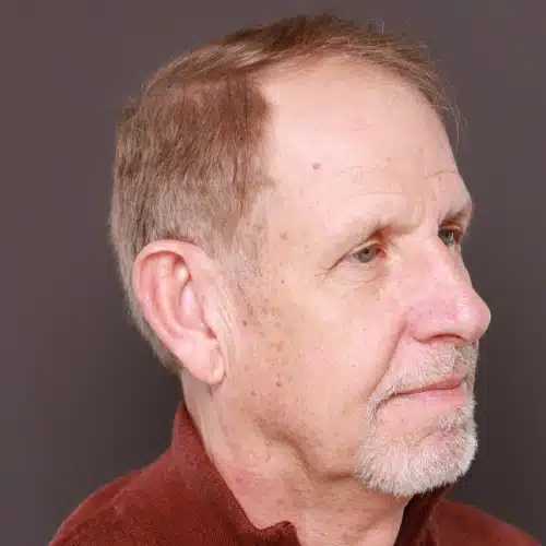 Before Image: FUE Hair & Brow Transplant, 2700 grafts - 