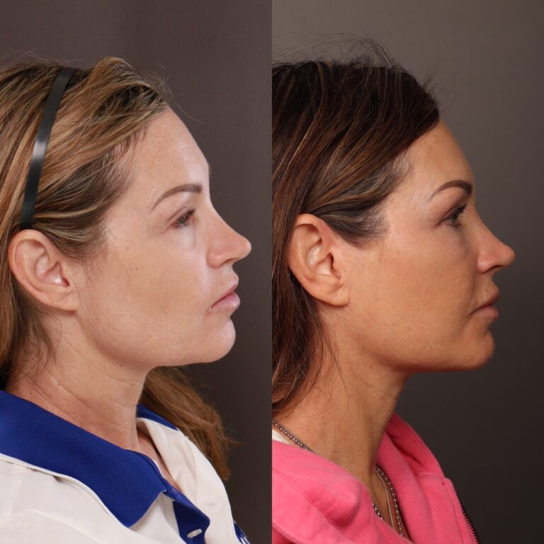 After Image: Deep Plane Facelift, Upper & Lower Bleph, Fat Grafting - front