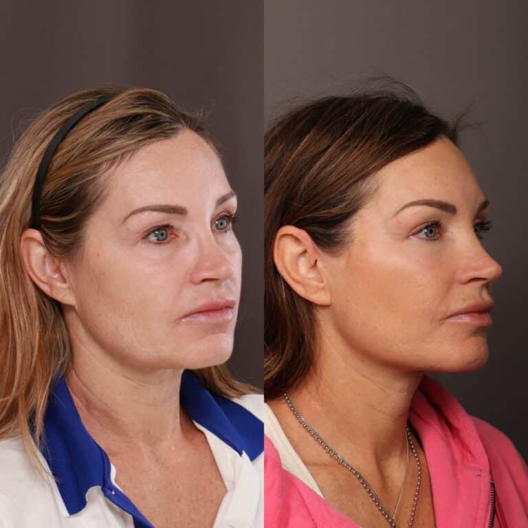 Before Image: Deep Plane Facelift, Upper & Lower Bleph, Fat Grafting - front