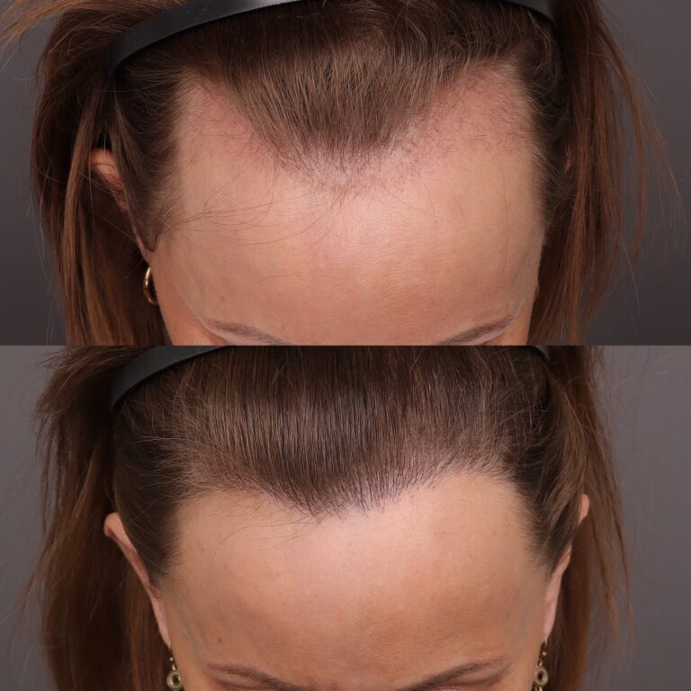 Before Image: 2000 Graft FUT Hair Transplant - 