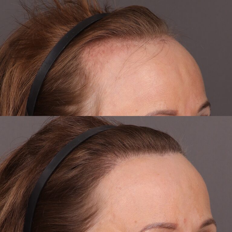 After Image: 2000 Graft FUT Hair Transplant - 