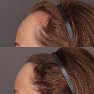 After Image: 2000 Graft FUT Hair Transplant