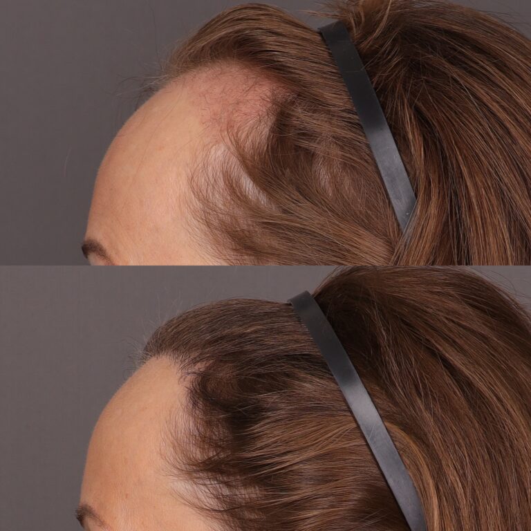 After Image: 2000 Graft FUT Hair Transplant - front