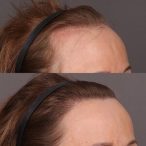 Before Image: 2000 Graft FUT Hair Transplant