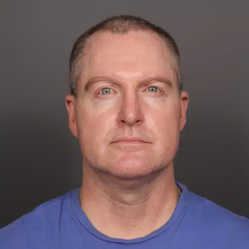 After Image: Eyebrow Transplant - front