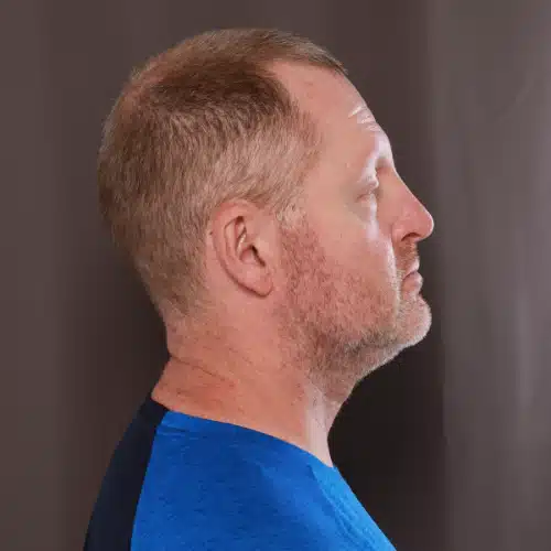 Before Image: Eyebrow Transplant - 