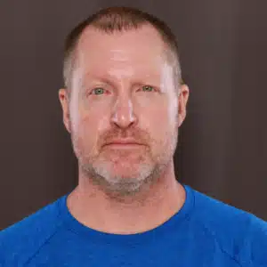 Before Image: Eyebrow Transplant