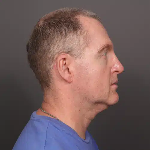 After Image: Eyebrow Transplant - 