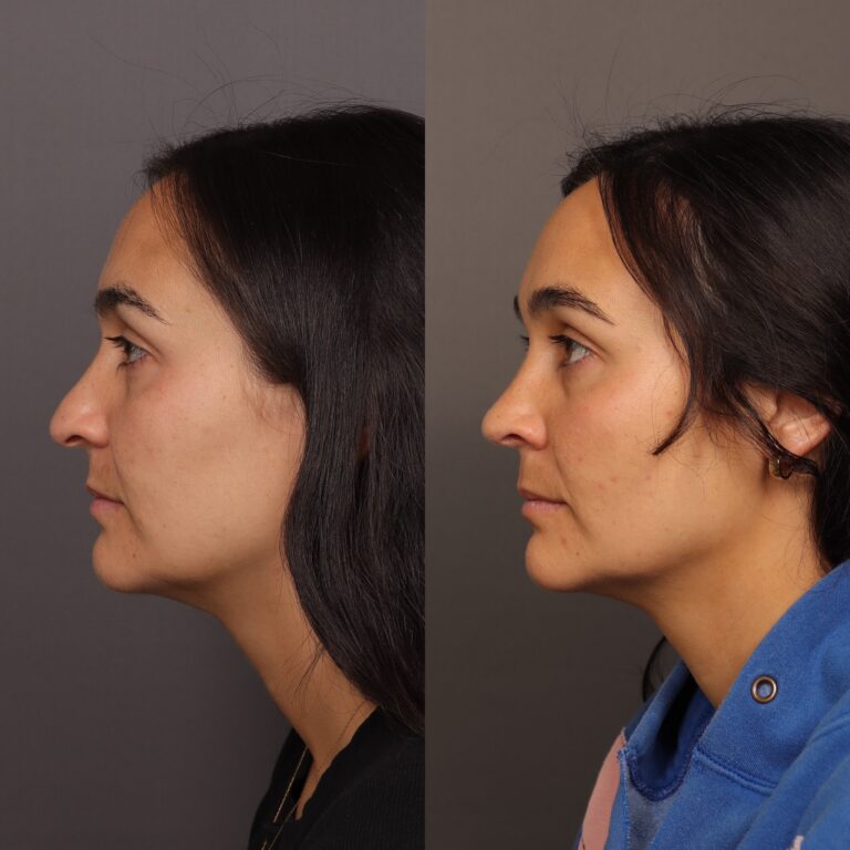 Before Image: Rhinoplasty by Dr. Thompson - front