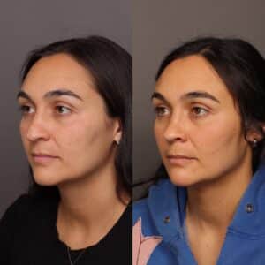Before Image: Rhinoplasty by Dr. Thompson